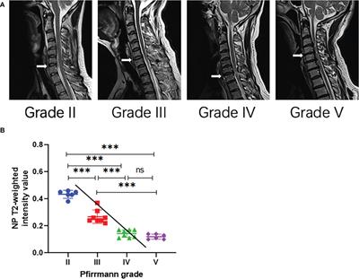 Identification of compositional and structural changes in the nucleus pulposus of patients with cervical disc herniation by Raman spectroscopy